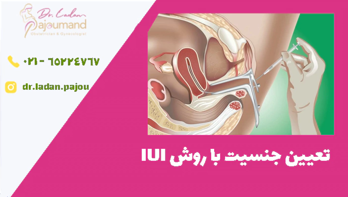 تعیین جنسیت با روش IUI