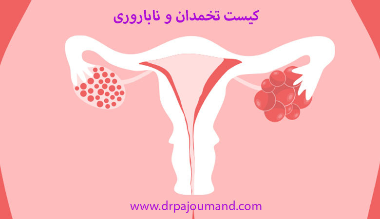 کیست تخمدان و ناباروری
