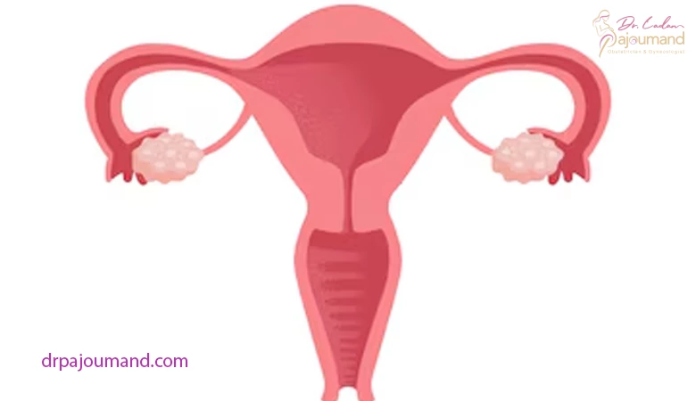 تاثیر ناهنجاری های رحم بر ناباروری