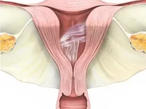 پیشگیری از چسبندگی رحم