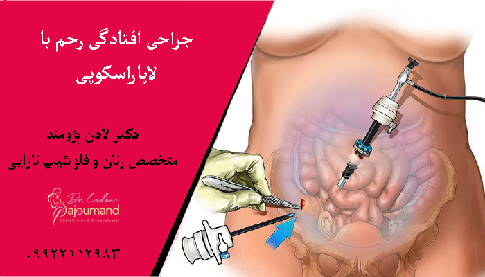 جراحی افتادگی رحم با لاپاراسکوپی