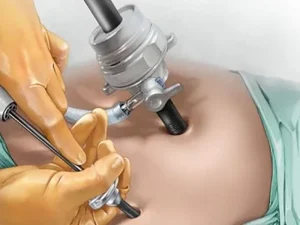 جراحی افتادگی رحم با لاپاراسکوپی