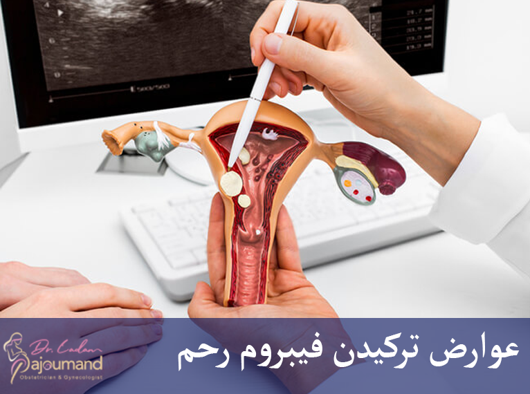 عوارض ترکیدن فیبروم رحم