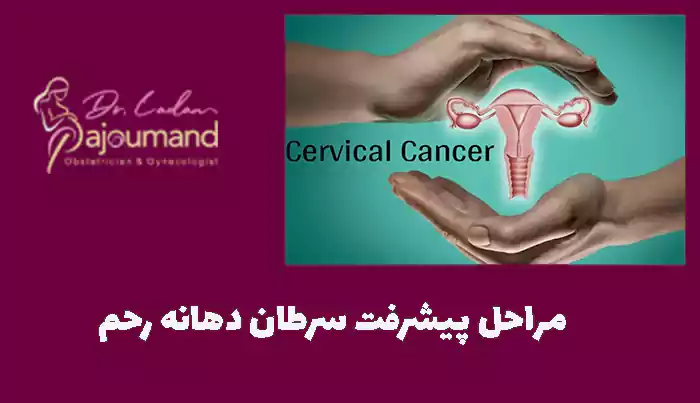 مراحل پیشرفت سرطان دهانه رحم