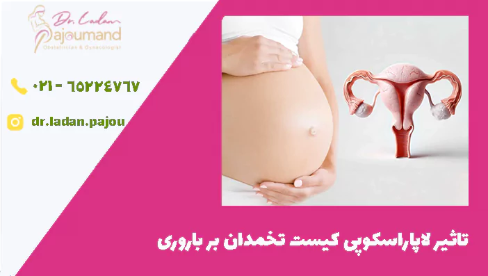 تاثیر لاپاراسکوپی کیست تخمدان بر باروری