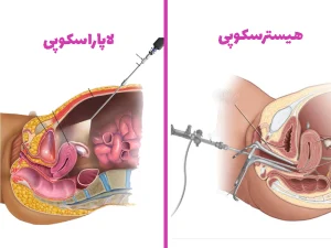 تفاوت هیستروسکوپی و لاپاراسکوپی