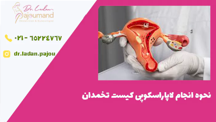 نحوه انجام لاپاراسکوپی کیست تخمدان