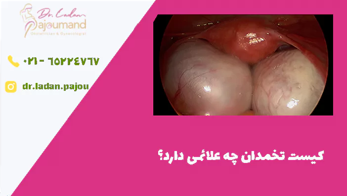 کیست تخمدان چه علائمی دارد؟